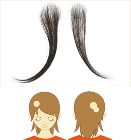 円形脱毛症 アプランパーシャル